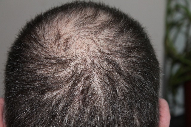 Haarausfall kann jeden treffen – auch Prominenten hilft eine Haarpigmentierung